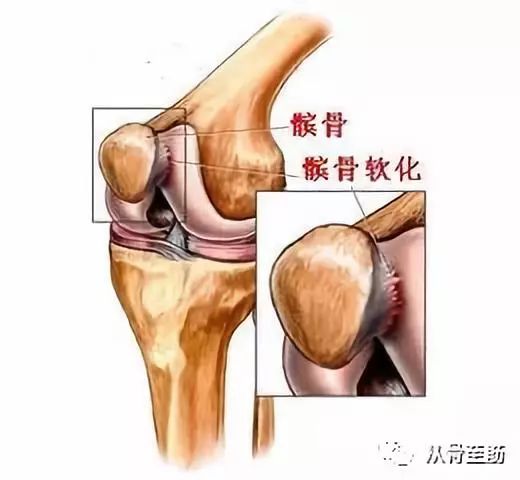 髌骨骨折六个月后膝盖肿胀，原因、治疗与康复