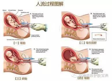 人流快一个月了还有血，原因、风险与应对措施